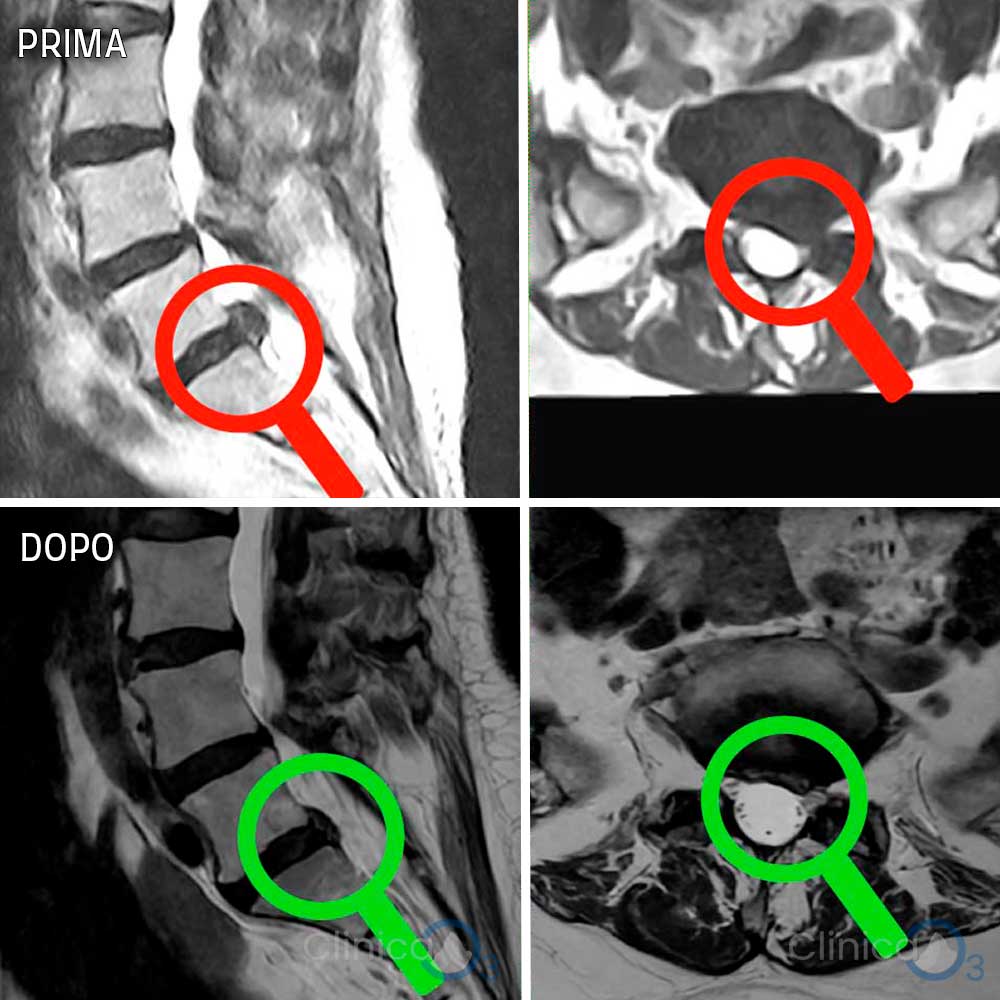 casi clinici ozonoterapia rx guidata scatalgia sn ernia discale