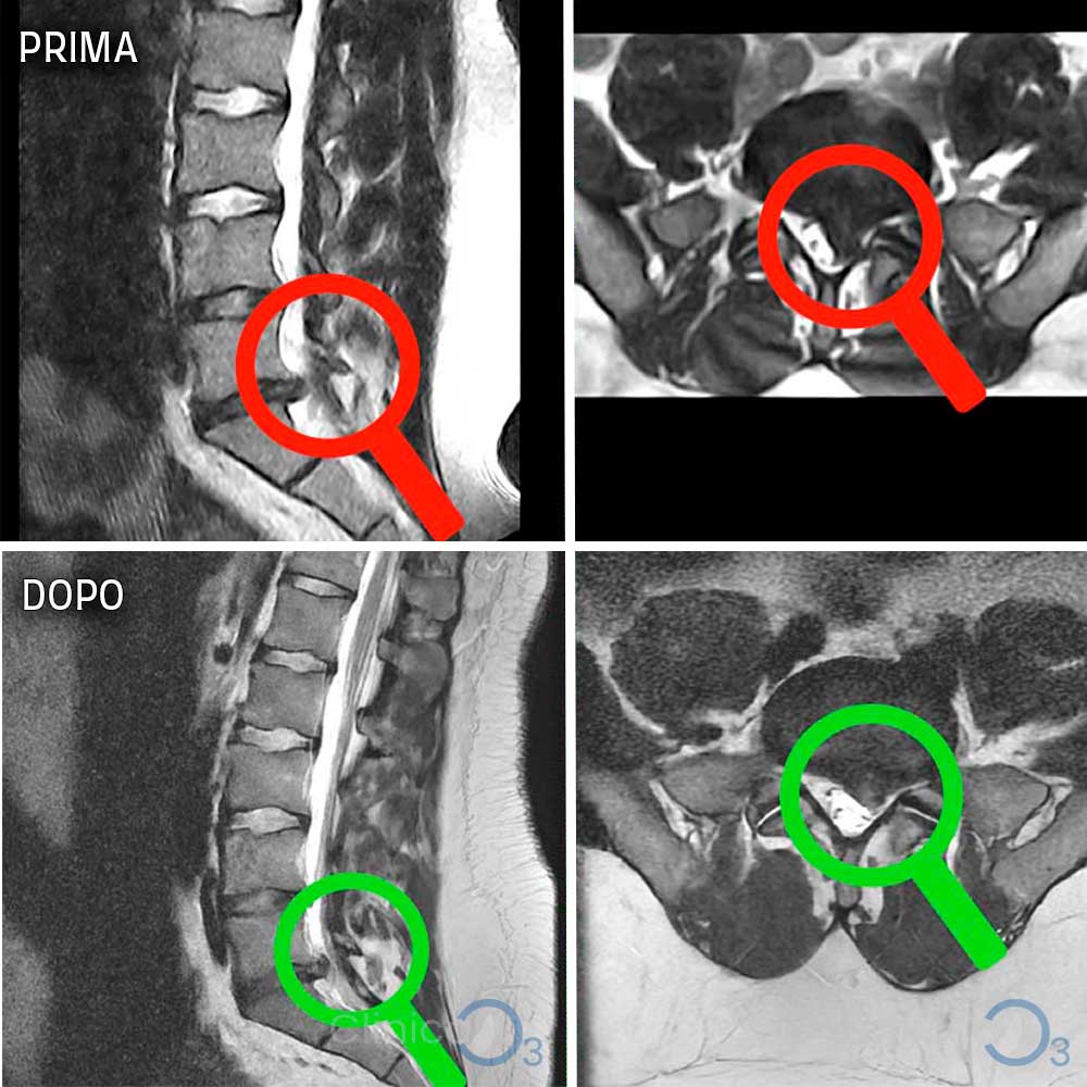 casi clinici ozonoterapia rx guidata scatalgia sn ernia discale