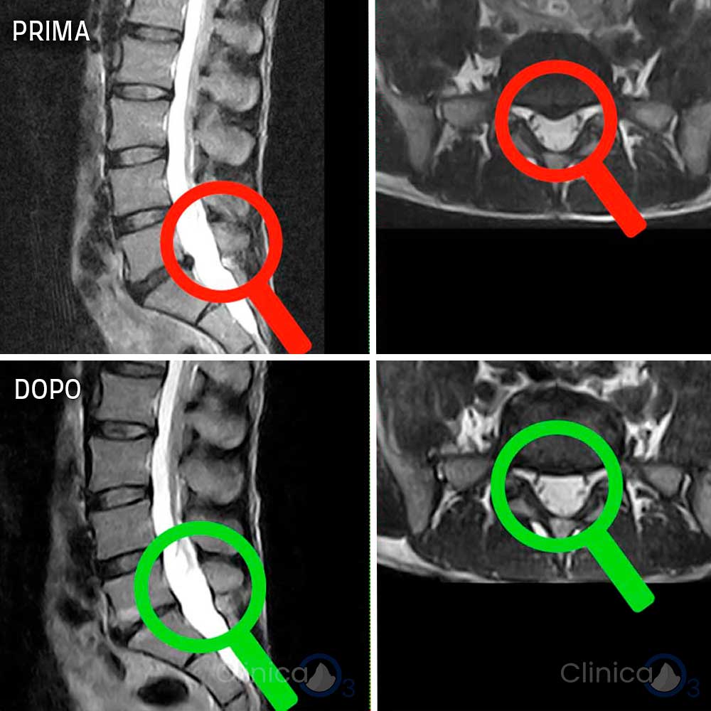 casi clinici ozonoterapia rx guidata scatalgia sn ernia discale