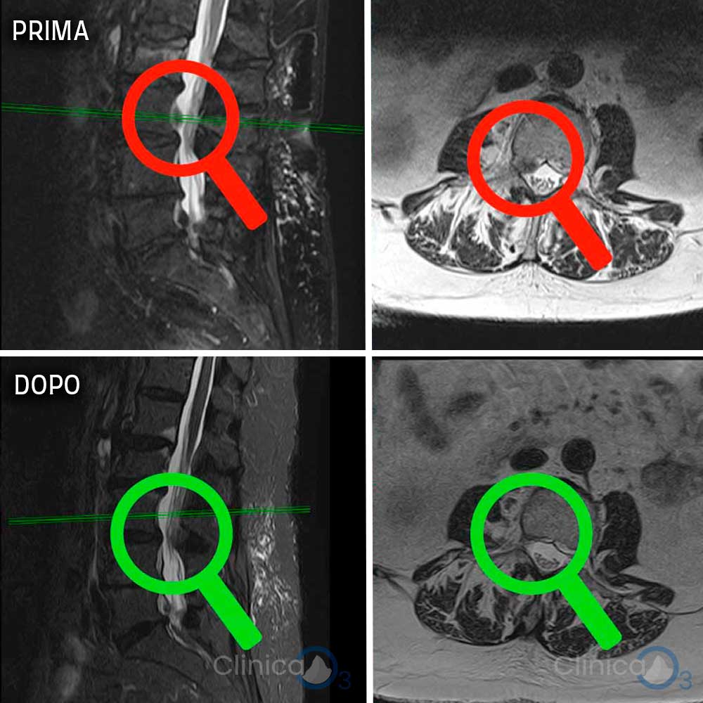 casi clinici ozonoterapia rx guidata scatalgia sn ernia discale